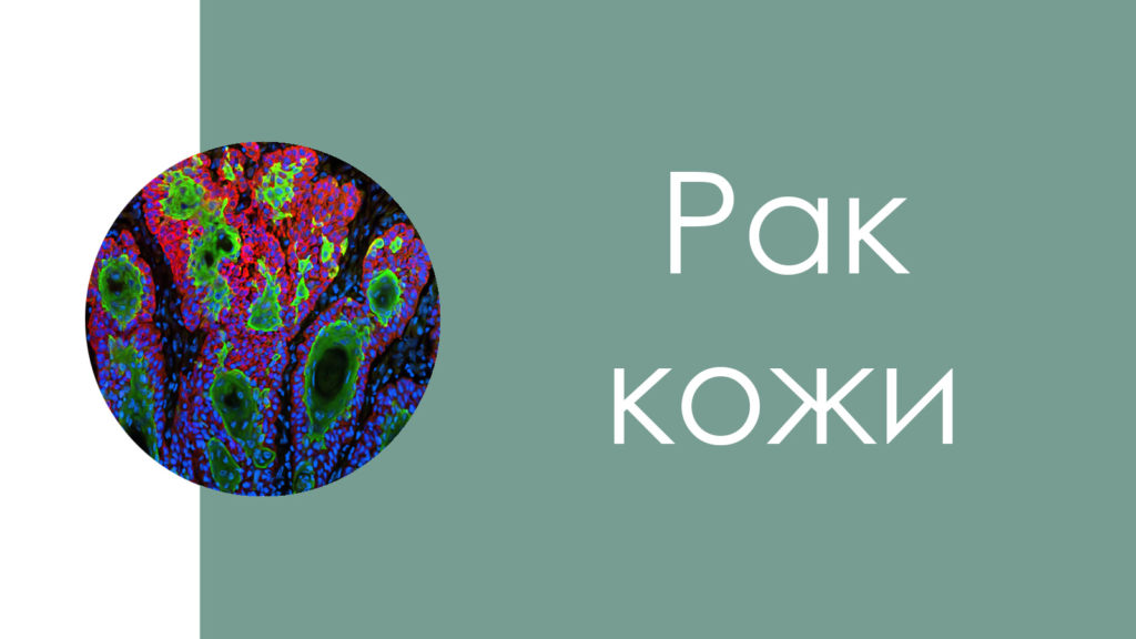 Рак кожи7