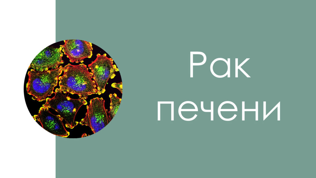 Рак печени7