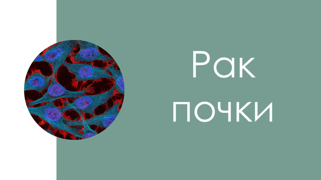 Рак почки7