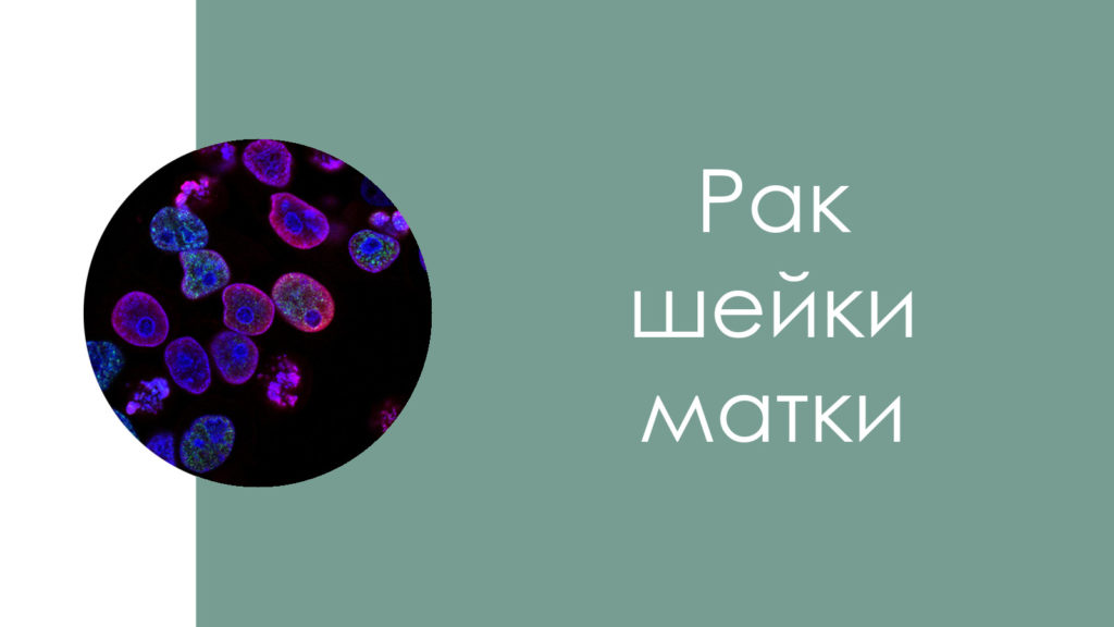 Рак шейки матки6