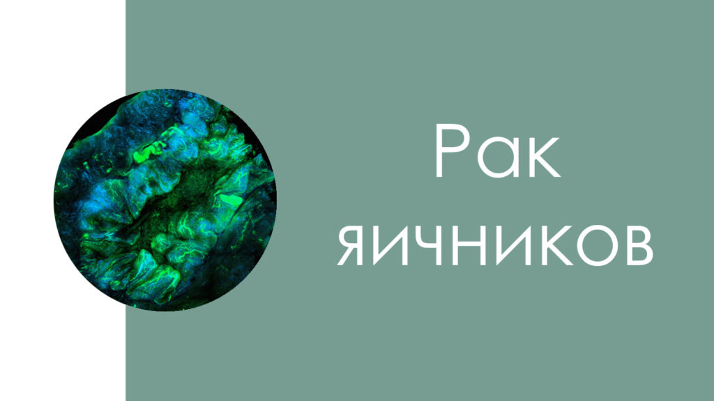 Рак яичников5