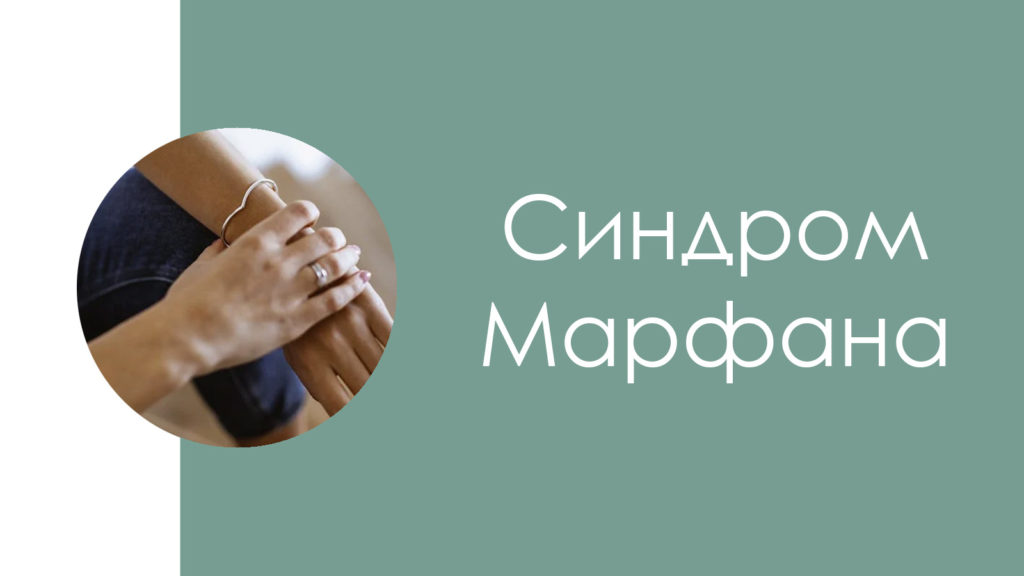 Синдром Марфана2